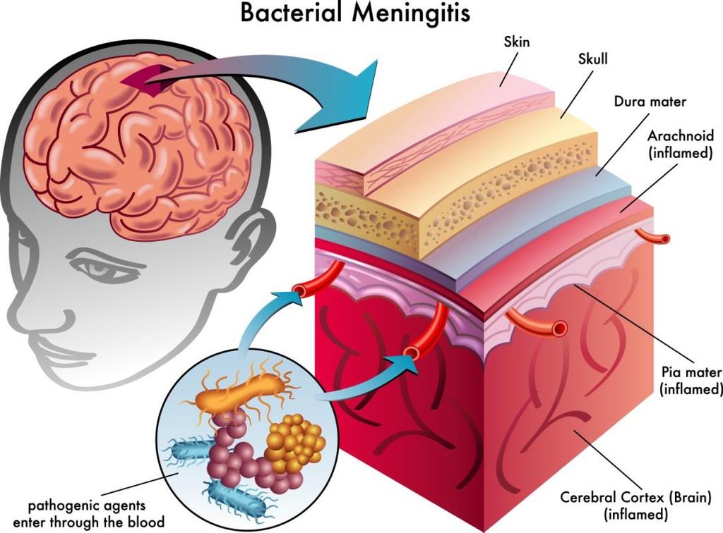 È un'infiammazione delle meningi, le membrane che ricoprono l'encefalo e il