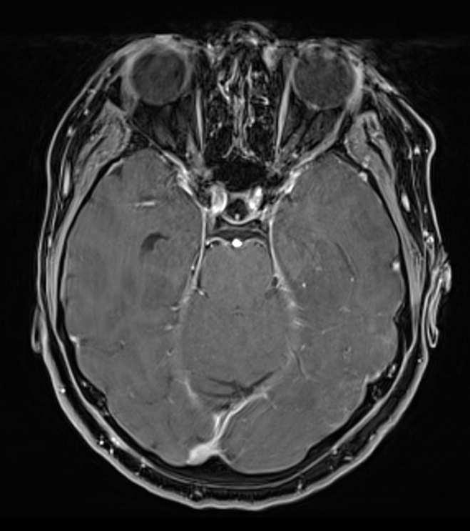 neurologica: vigile, mutacica, non esegue ordini, sfumata emisindrome motoria