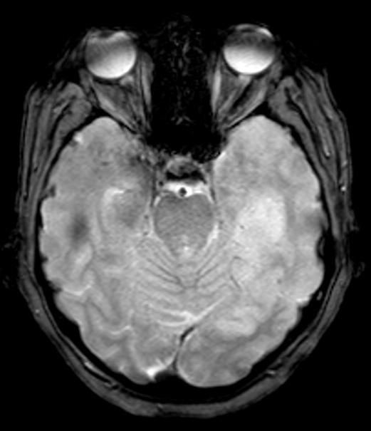 GENERALIZZATA TONICO-CLONICA La paziente viene trasferita in Stroke Unit