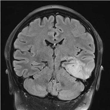 ALTRO? IPOTESI DIAGNOSTICHE: ENCEFALITE DA CMV (?