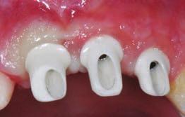 Valutazione preliminare clinica e radiografica del sito da trattare Una prima valutazione del sito da trattare consentirà un generale inquadramento del caso stesso e guiderà gli step successivi. 3.