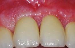 In presenza di difetti ossei, l analisi dei modelli in gesso, associata alla ceratura diagnostica eseguita dall odontotecnico consentirà di visualizzare le unità dentali che devono essere