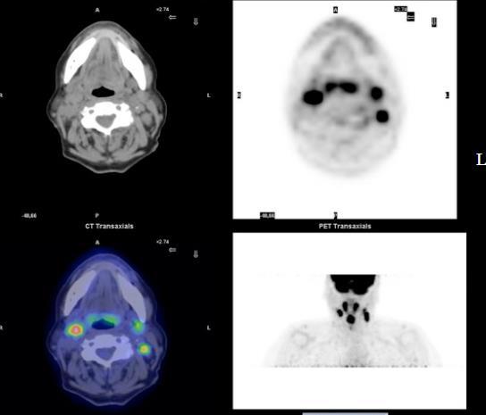 FDGPET E LINFONODI LATEROCERVICALI Parametro N Metastasi linfonodali si riscontrano nel 50% dei pazienti alla diagnosi La valutazione del