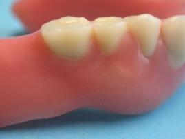 L'inserto di montaggio può e deve essere rimosso solo al termine della polimerizzazione della matrice nella protesi dentaria utilizzando lo
