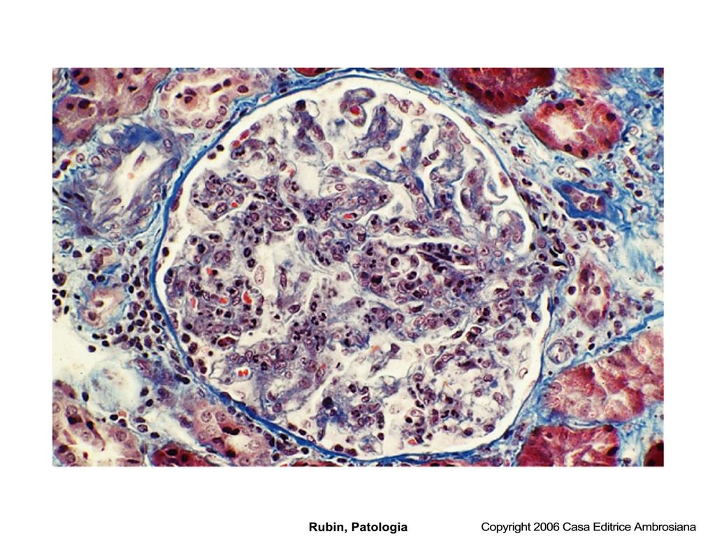 Glomerulonefrite