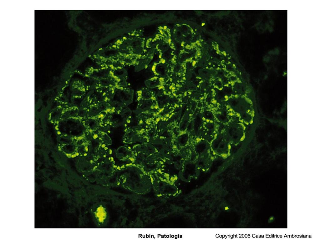 Glomerulonefrite acuta post-infettiva