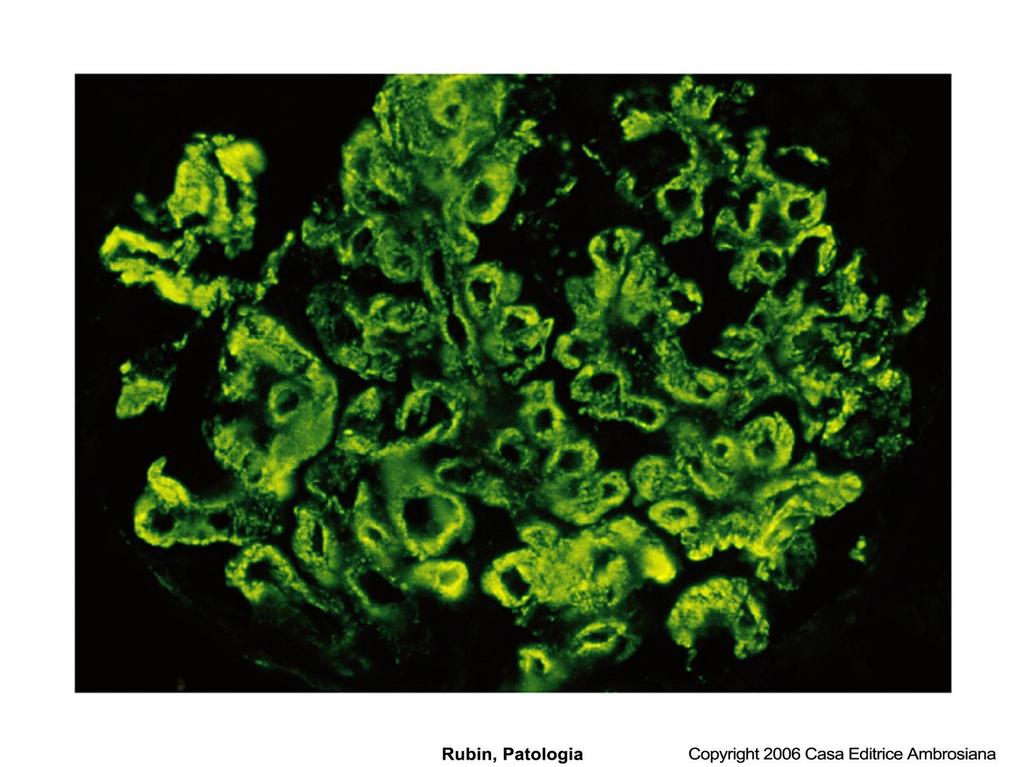 Glomerulonefrite