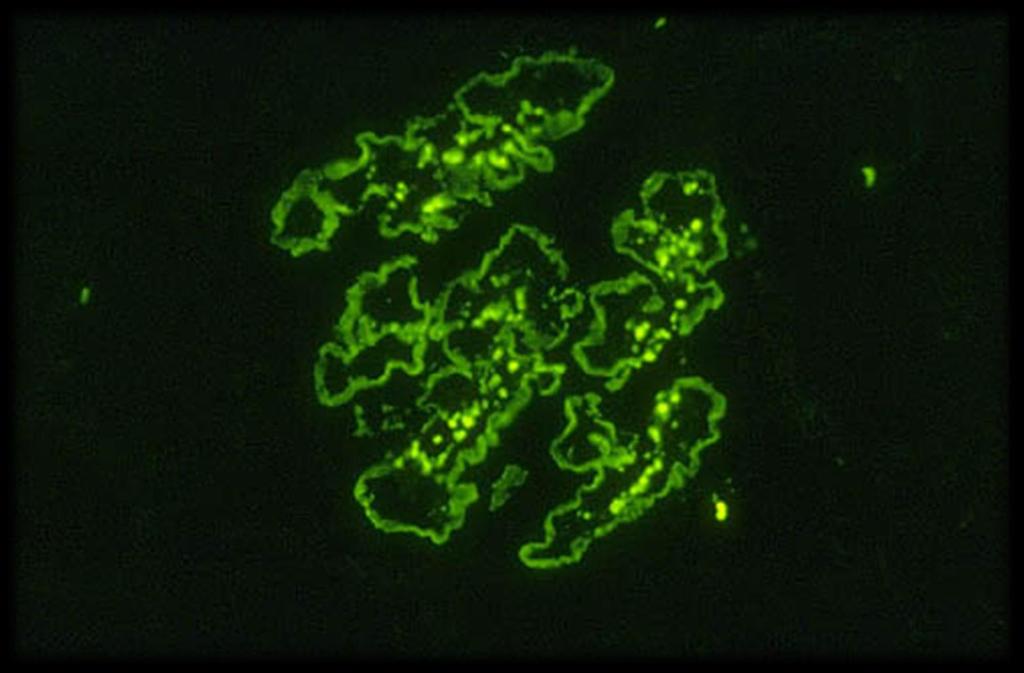 Glomerulonefrite