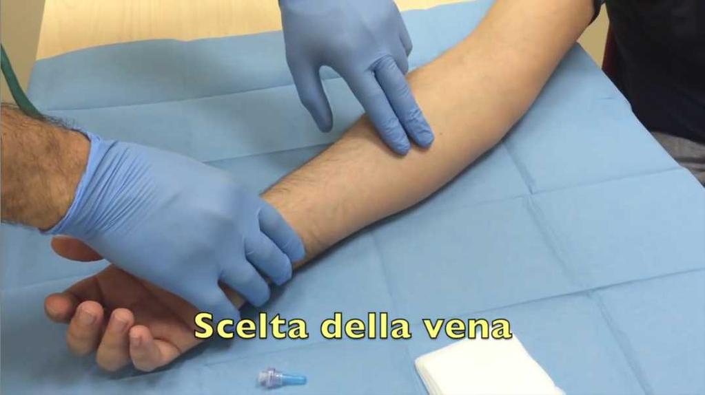 Sito per la venipuntura Per ridurre il rischio di CR-BSI e flebi, da catetere venoso periferico è preferibile il sito d impianto sull arto superiore negli adul, e sos,tuire non appena possibile un