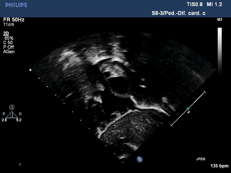 Approccio segmentario-sequenziale: II) situs atriale Atrio morfologicamente destro Ø Ø Ø Ø Muscoli pettinati nell auricola e nella giunzione