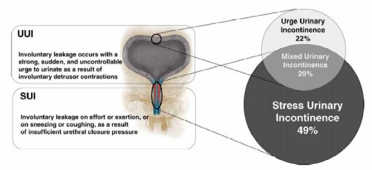 FISIOPATOLOGIA dell INCONTINENZA Per il mantenimento della continenza, la pressione che vige all interno dell uretra deve essere maggiore della pressione all