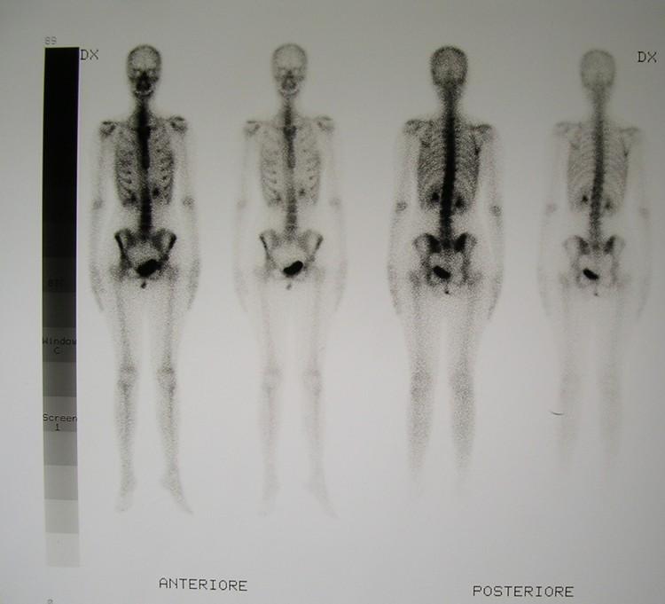 CASO CLINICO-RADIOLOGICO Scintigrafia ossea -