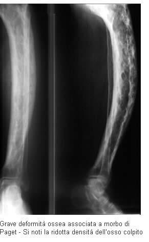 generalizzato come l osteoporosi Aumento dell attività osteoclastica, aumento del turnover osseo Dolore alle