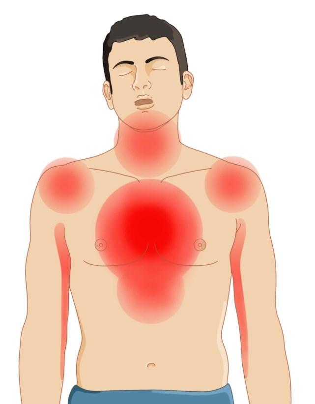 Corso BLS esecutore SEGNI E SINTOMI Dolore o peso retrosternale Possibile irradiazione del dolore a: - Braccio sinistro - Spalle - Epigastrio