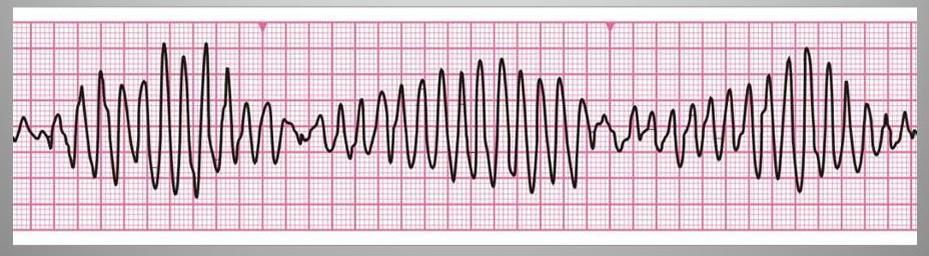 Complesso QRS?