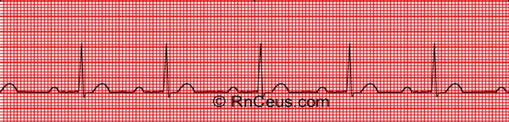 Ogni onda P è seguita da un complesso QRS, ma è presente un ritardo un