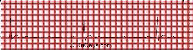 BLOCCO A-V DI SECONDO GRADO - Mobitz 2 P non condotta P non condotta Frequenza : frequenza atriale maggiore di quella ventricolare Ritmo: ritmo atriale regolare e ventricolare irregolare Onde P: