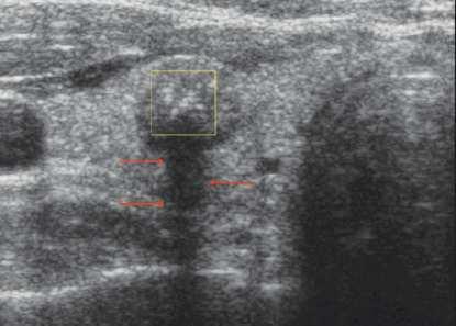 Calcificazioni Microcalcificazioni Macrocalcificazioni Periferiche o rima calcifica