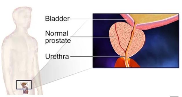 Caso #1 Uomo di 67 anni, affetto da PD da 7 anni. Riferisce un aumento della frequenza urinaria associata ad urgenza. L esame delle urine e l urinocoltura sono non significativi.