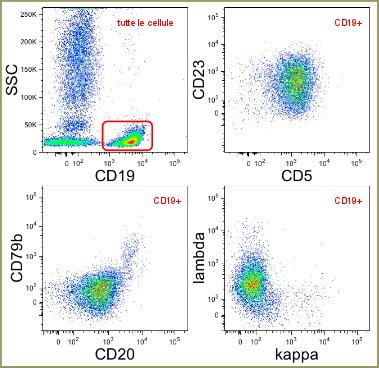 Diagnosi CLL-B: Immunofenotipo CD19 CD5 CD23 + +