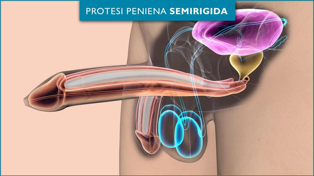 protesi non idraulica Nel caso di impianto di protesi semirigida o soffice le complicanze possono essere: ematoma penieno; lesione dell uretra con perforazione della stessa e epicistostomia