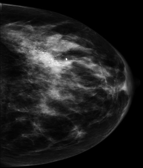 (neoangiogenesi tumorale) nella ghiandola mammaria