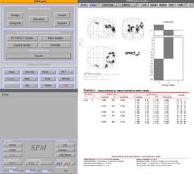 FDG-PET SPECT: