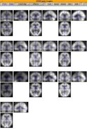 MAPPING HMPAO-SPECT