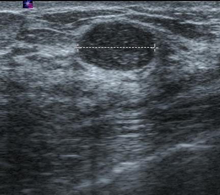 lesions Stavros AT, Radiology 1995;196(1):123 134 La