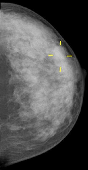 Indicazioni alla citologia mammaria L approccio diagnostico ai noduli mammari si basa sull integrazione di: Esame clinico Esame radiologico Esame citologico Quali pazienti sottoporre