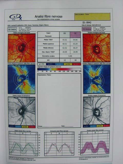 GDx polarimetria a scansione laser mappe