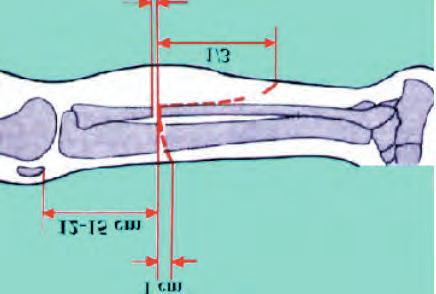 AMPUTAZIONE TRANSTIBIALE Manuale Dispositivi Ortopedici - Protesi di arto inferiore La lunghezza del moncone che presenta la migliore proporzione possibile tra parti molli ed osso in funzione