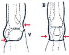 stabilizzare, soprattutto, le amputazioni di gamba molto prossimali.