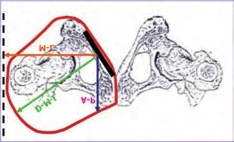 contenimento del ramo ischiatico. Affinché ciò si realizzi, Fig. 5 bisogna far sì che l'angolo formato tra il bordo superiore della paletta e la linea di progressione del movimento (L.O.P.