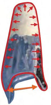 di tali angoli). Il valore esatto dell'angolo viene rilevato durante l'acquisizione del calco in gesso e riportato sull'invaso in fase di stilizzazione del positivo.