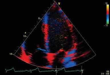 Color Doppler