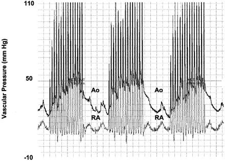 RAZIONALE 30 : 2 Le interruzioni della CPR per la ventilazione compromettono la perfusione coronarica Berg RA, Circulation 2001;104:2465 Possibili effetti emodinamici sfavorevoli dell