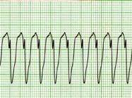 cardiopatie congenite 15% Cardiomiopaie 80% Cardiopatia ischemica American Heart Association.