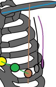 Corretta posizione degli elettrodi precordiali Elettrodo V5: individuate la linea ascellare anteriore, più o meno dove inizia l incavo ascellare, e seguendo, il 5 spazio intercostale.