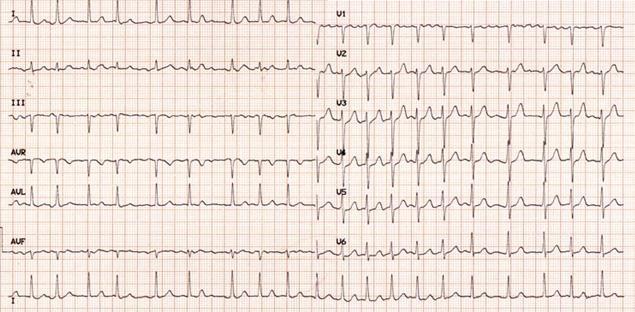Elettrocardiogramma Nel paziente Aritmico vanno registrati almeno 6 complessi per