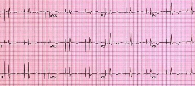 Paziente portatore di Pace Maker L ECG di un paziente portatore di pacemaker presenterà una riga verticale