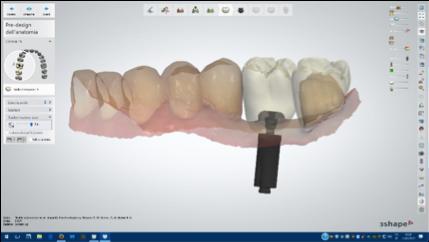 Figura 5: Posizionamento dell analogo digitale Elos per Zimmer