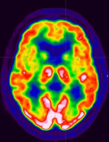 SPECT cerebrali Traccianti di perfusione: 99m Tc-HMPAO e 99m Tc-ECD Misura semi-quantitativa della distribuzione del radiofarmaco, correlata al Flusso Ematico Cerebrale