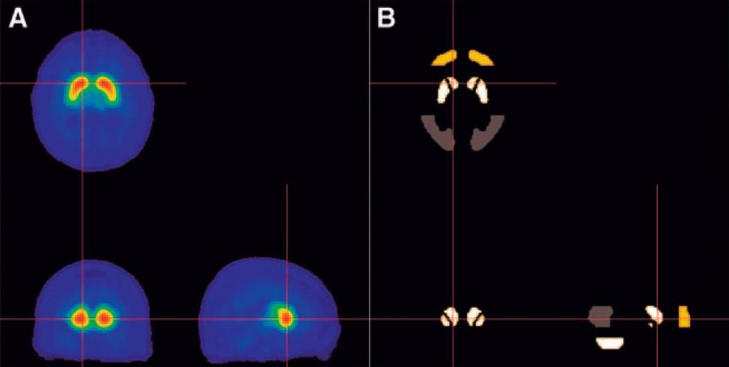 Template di VOI (3D) Pregi: riproducibilità inter- e intra-observer considerano tutto il