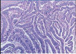 LESIONI RESECABILI Lesione solida sospetta per PDAC (adenocarcinoma duttale pancreatico) PanIN-3