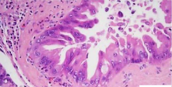 grado e frequenti mitosi) HGD/CARCINOMA-IPMNs (neoplasie papillari mucinose intraduttali ad alto grado