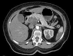 Ecoendoscopia