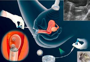 in questione, la PGD permette l individuazione ed il trasferimento in utero dei soli embrioni sani, evitando quindi l eventualità di avere una gravidanza con feto affetto da grave patologia.