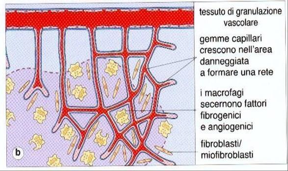 Fasi della guarigione delle ferite (2) Contemporaneamente iniziano: Proliferazione di cellule endoteliali e fibroblasti tessuto di granulazione che inizia a formarsi entro 72 ore e che prosegue per i