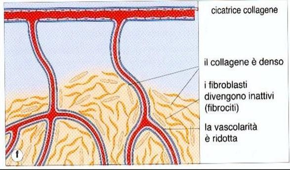 Fasi della guarigione delle ferite (4) Regressione dei vasi e conversione del tessuto di granulazione, roseo ed edematoso, in una pallida cicatrice fibrosa Entro 4-5 settimane guarigione completa con